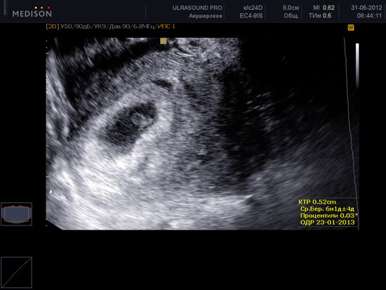 5 6 Недель Беременности Фото Эмбриона